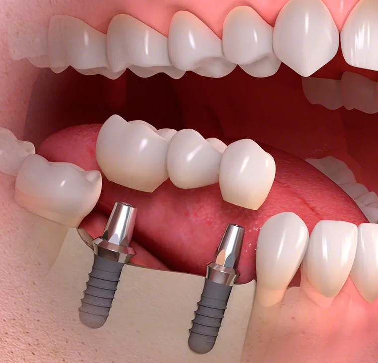Имплантация зубов: этапы, установка зубного импланта пошагово — клиника доктора федорова