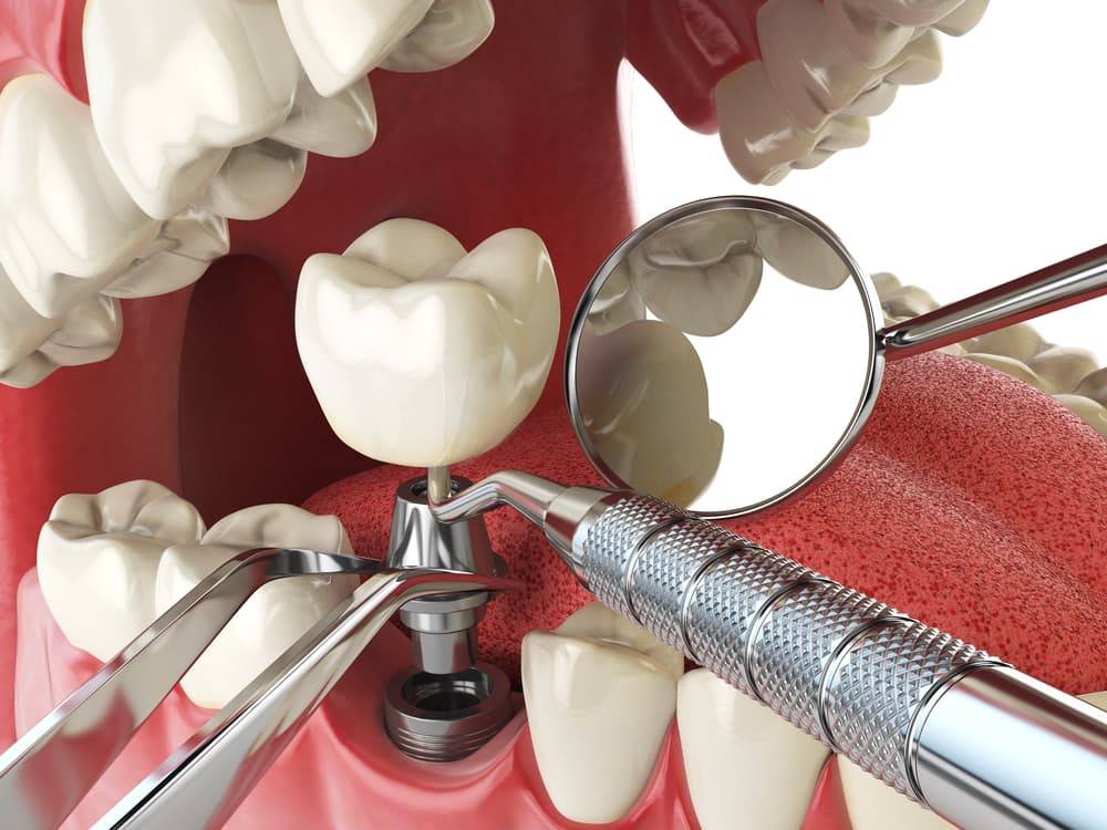 Статья о стоматологии: так ли вам нужны импланты, как вы думаете?