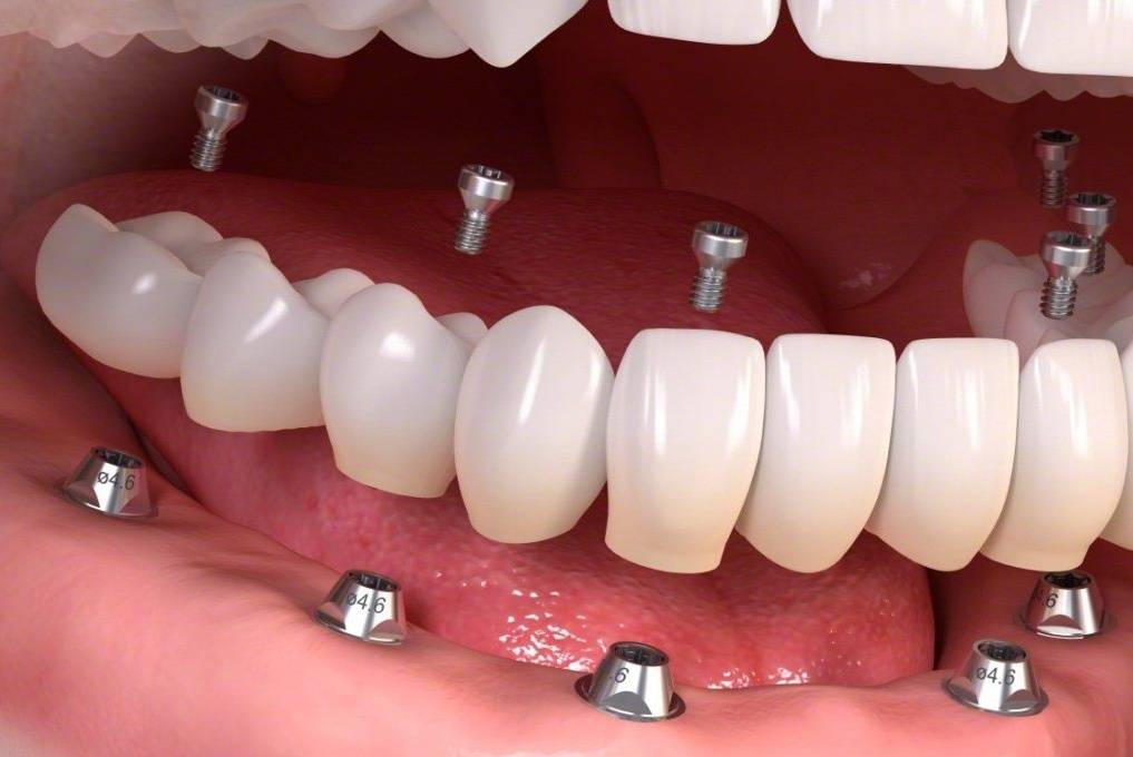 Установка имплантов под ключ, за что придется доплатить | недорогая стоматология