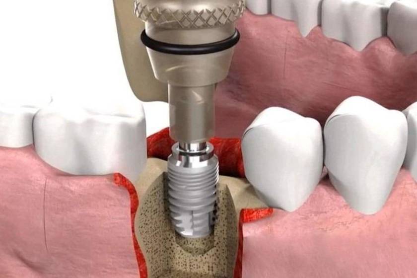 Технология имплантации зубов: этапы