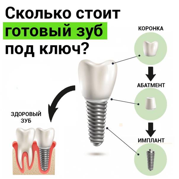 Что такое имплантация зубов и как она делается