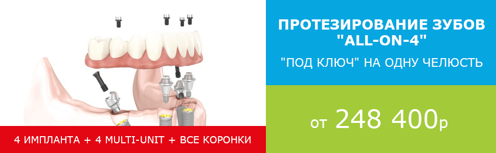 Зубы в рассрочку. Рассрочка на протезирование зубов. Рассрочка в стоматологии на протезирование. Импланты зубов в рассрочку. Зубной протез в рассрочку.