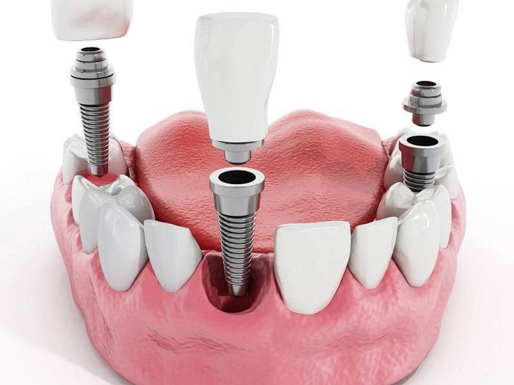 Как ставят импланты зубов: пошагово, сроки, фото, видео
