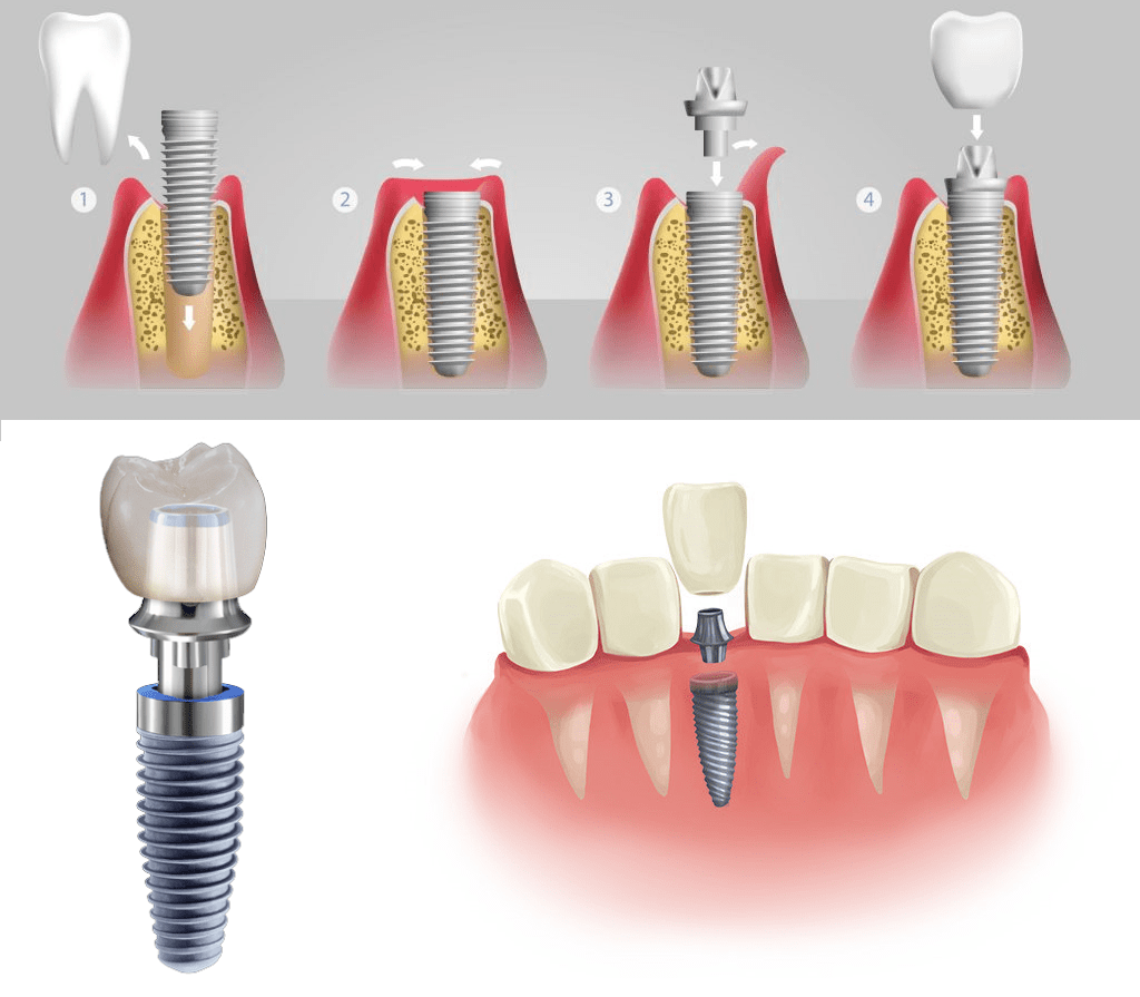 Как подготовиться к имплантации зубов - стоматология  щелково. сеть клиник «улыбка»