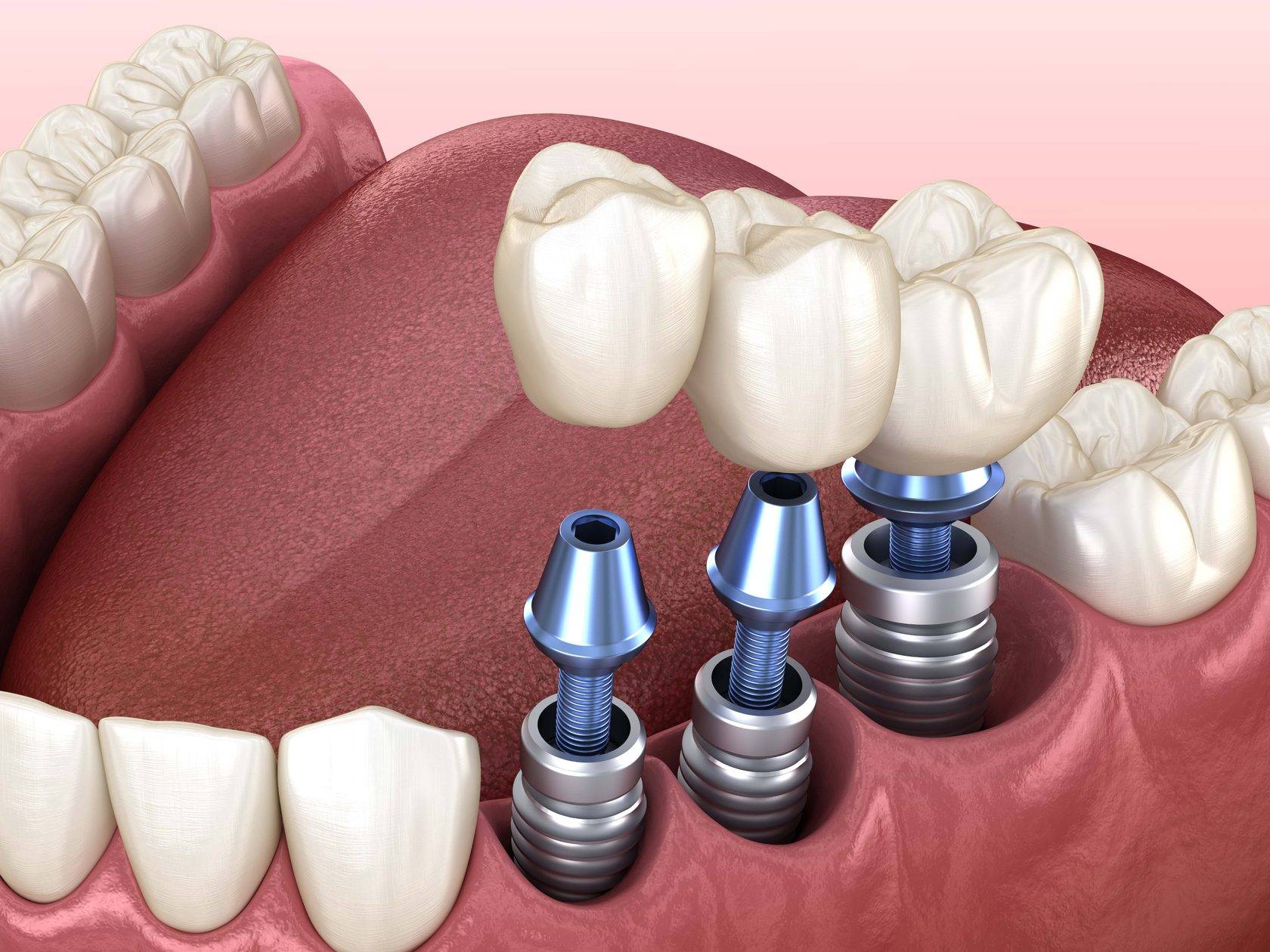 Имплантация зубов — этапы, виды, фото, как делают операцию по установке зубного импланта?