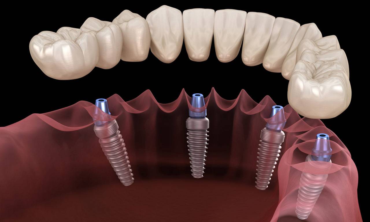 Все, что нужно знать об имплантации зубов – стоматология президент