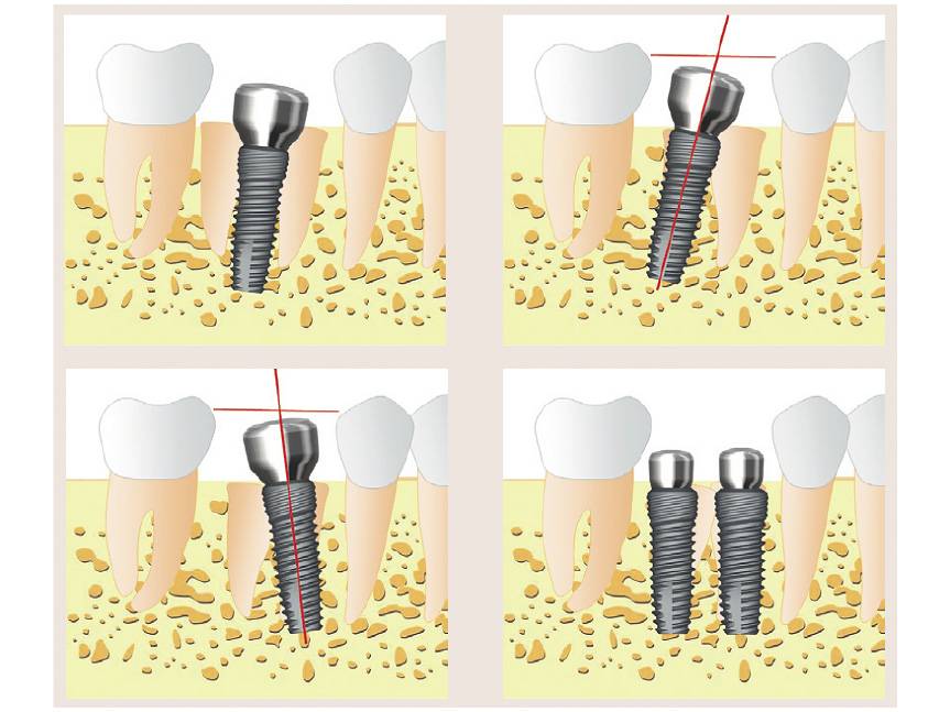 Имплантация зубов — этапы, как происходит операция, сроки