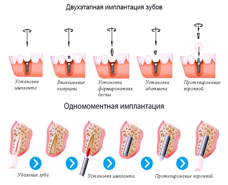 Отличия зубов и имплантатов