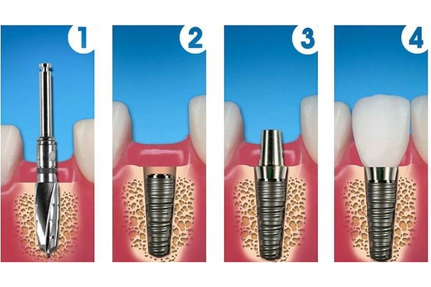 Операция по имплантации зубов: порядок и технология установки имплантов