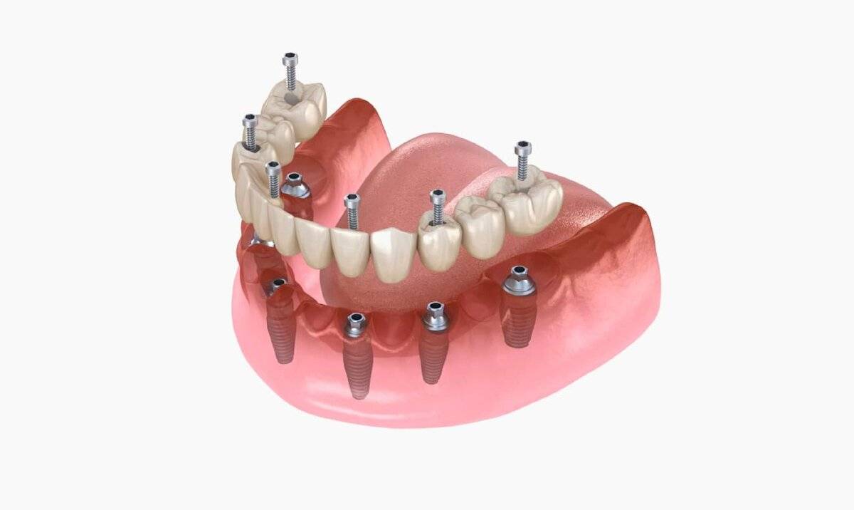 Все, что вы должны знать об имплантации зубов