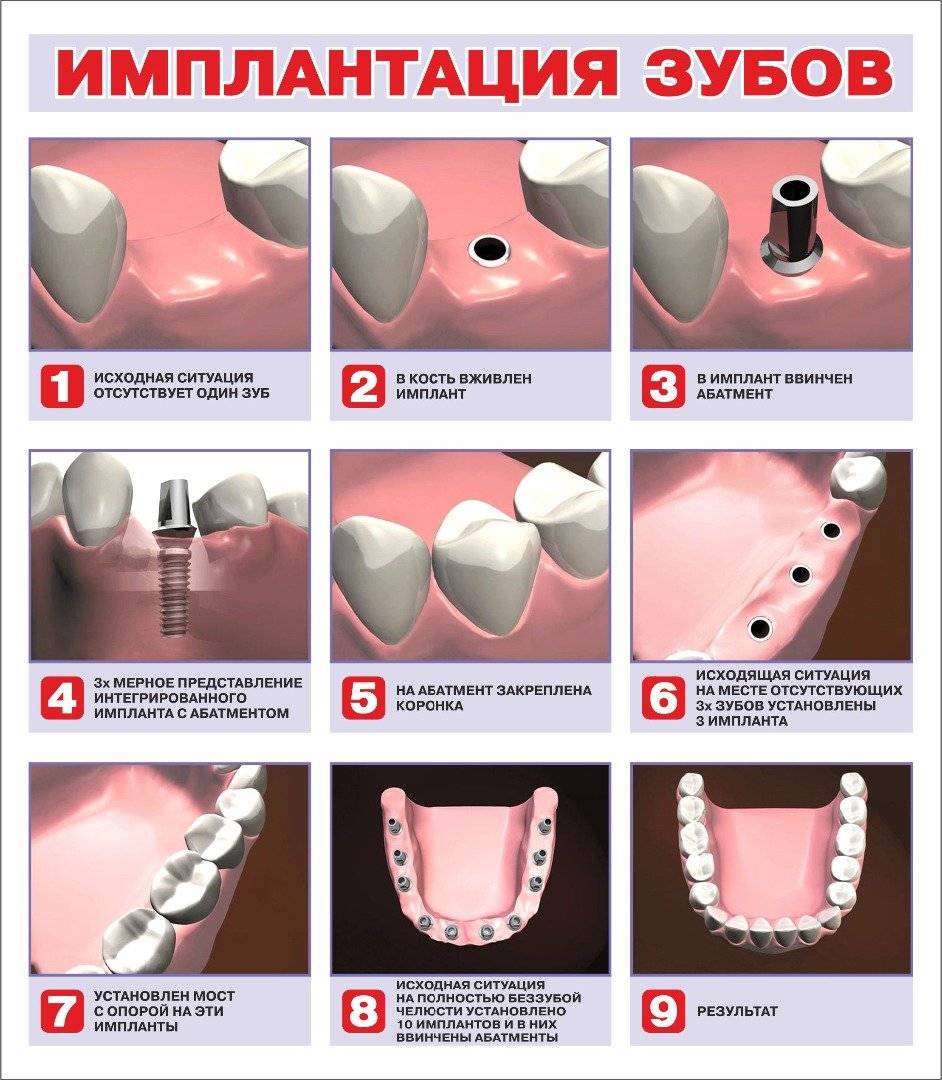 Какую имплантацию зубов выбрать: одномоментную или двухэтапную