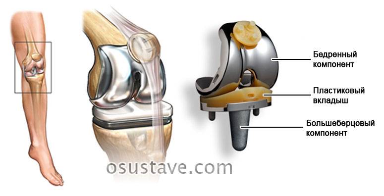 Замена тазобедренного сустава по квоте: как получить и оформить